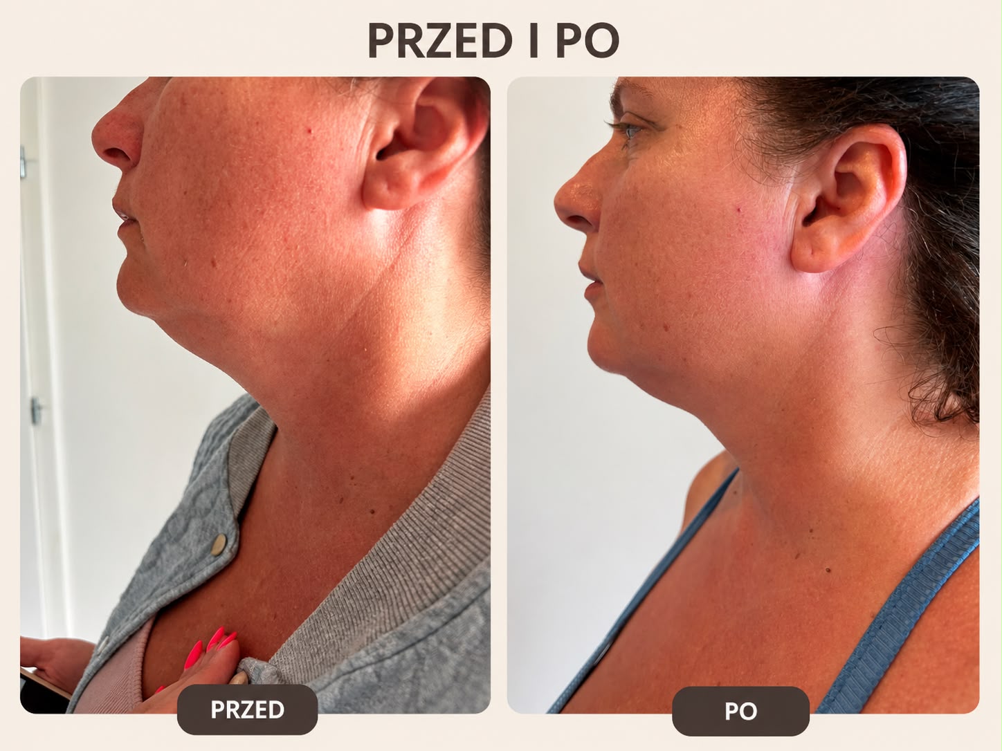 Podbródek: przed po lewej, po po prawej